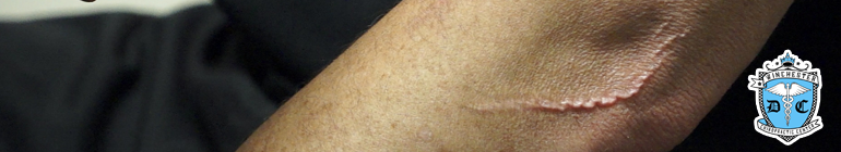 A closeup of an injured elbow needing chiropractic maintenance.
