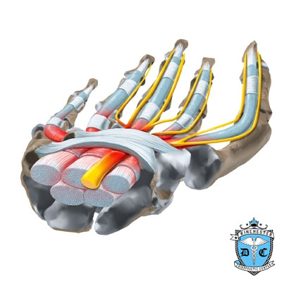 Illustration of Carpal Tunnel Syndrome (CTS).