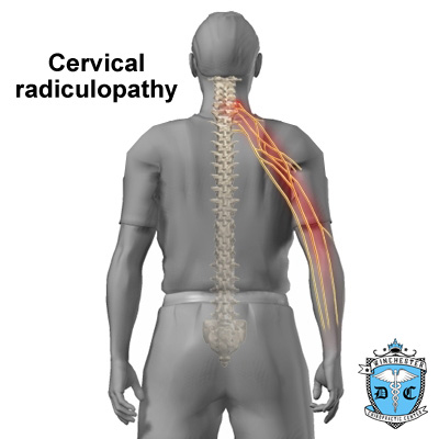 Illustration of cervical radiculopathy.