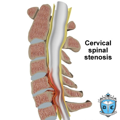 Illustration of cervical stenosis.