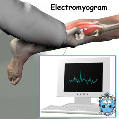 Illustration of stenosis treatment via electromyogram treatment.