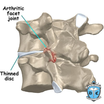 Illustration of the cause of facet joint arthritis.