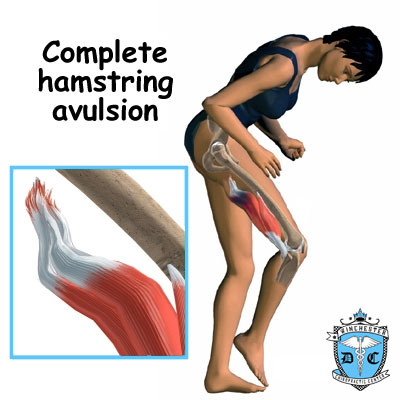 Illustration of hamstring-avulsion.