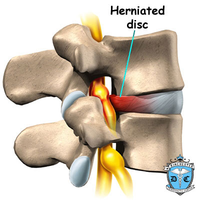 Illustration of disc herniation.