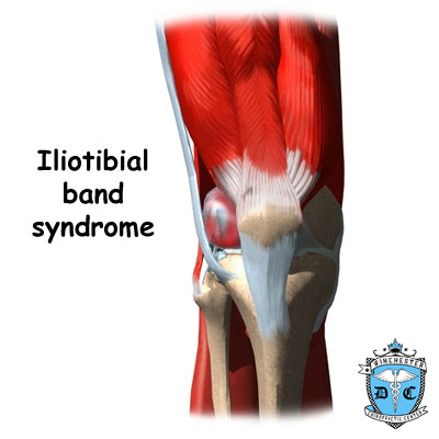 Illustration of iliotibial band syndrome.