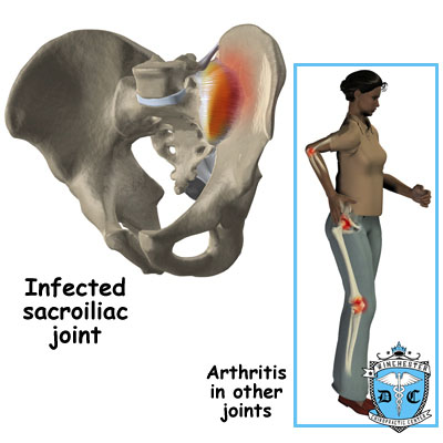 Illustration of an infected sacroiliac joint.