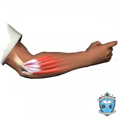 Illustration of lateral epicondylitis.