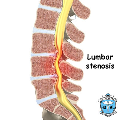 Illustration of lumbar stenosis.