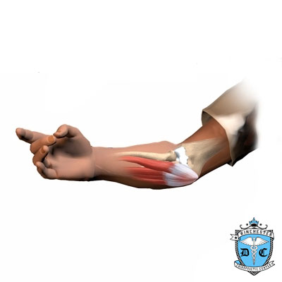 Illustration of medial epicondylitis.