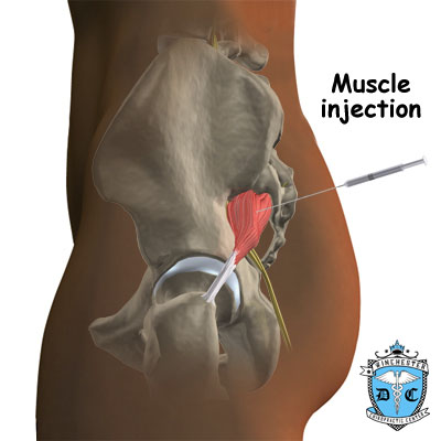 Illustration of piriformis muscle injection.