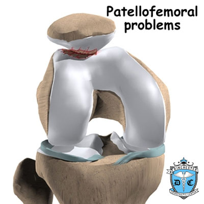 Illustration of patellofemoral problems.