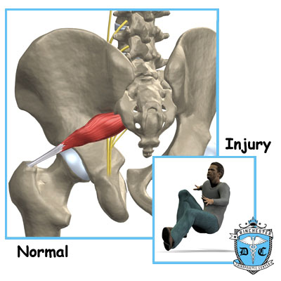 Illustration of piriformis cause.