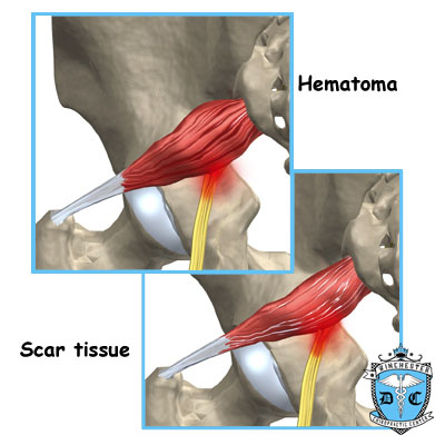 Illustration of piriformis hematoma.