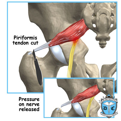 Illustration of piriformis tendon cut.