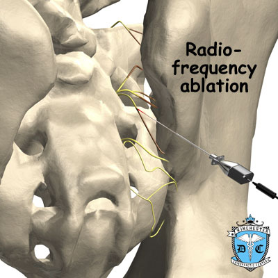 Illustration of radio frequency ablation treatment.