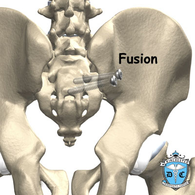 Illustration of SI joint surgery treatment.