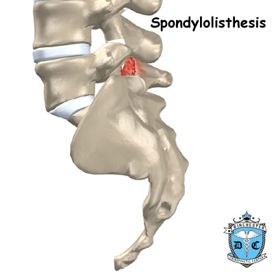 Illustration of spondylolisthesis.