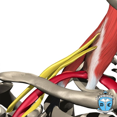 Illustration of thoracic outlet syndrome (TOS).