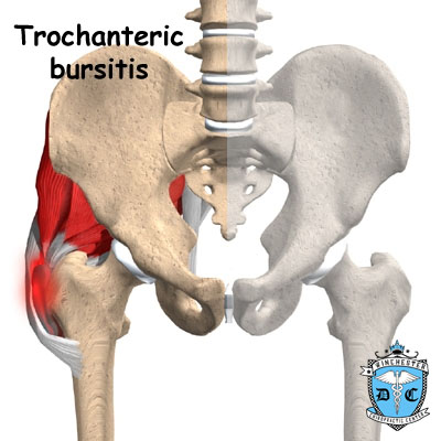 Illustration of trochanteric bursitis.